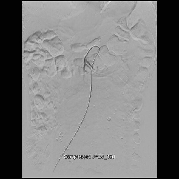 File:Abernethy malformation (Radiopaedia 42006-45462 Frontal Superior mesenteric artery 2).jpg