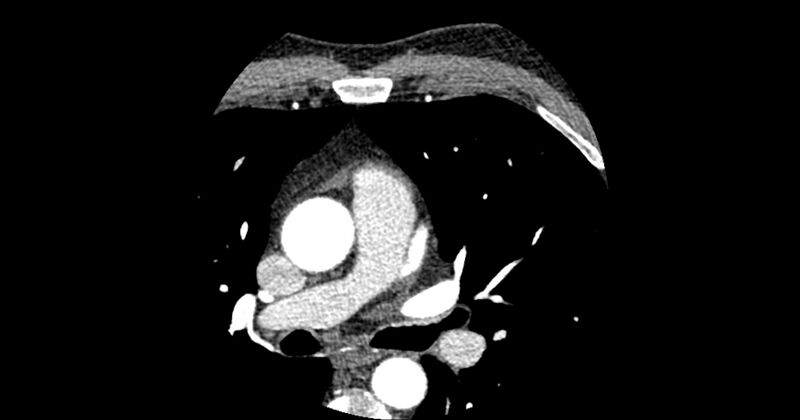 File:Aberrant left main coronary artery (ALMCA) arising from the right sinus with interarterial course (Radiopaedia 63251-71814 Axial C+ arterial phase 31).JPG