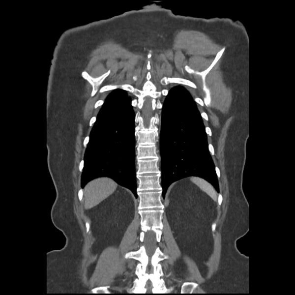 File:Aberrant right subclavian and left vertebral arteries (Radiopaedia 43467-46847 Coronal C+ portal venous phase 71).jpg