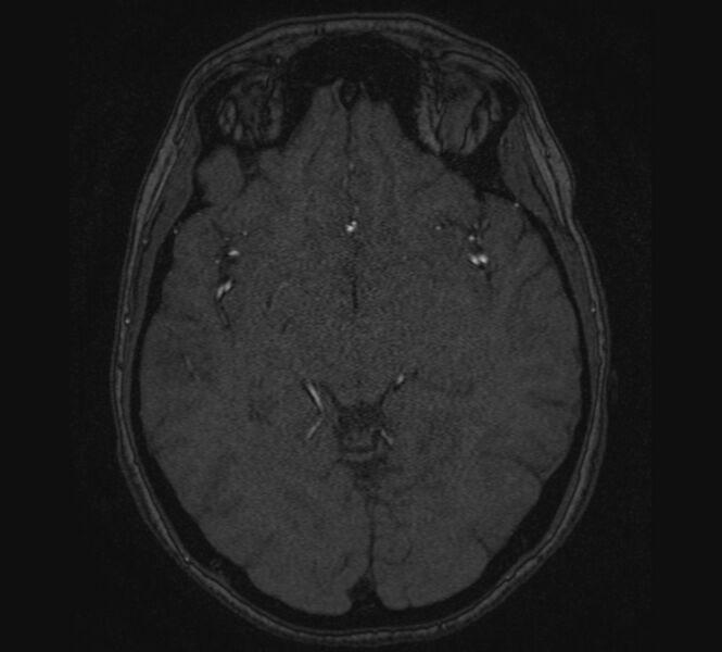 File:Accessory middle cerebral artery and ICA aneurysm (Radiopaedia 22656-22674 MRA 63).jpg
