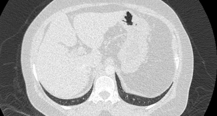 Accessory right inferior hepatic vein (Radiopaedia 65245-74259 Axial lung window 74).jpg