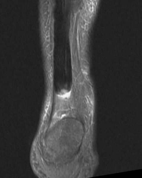 File:Achilles tendon tear (Radiopaedia 2572-6268 Coronal STIR 1).jpg