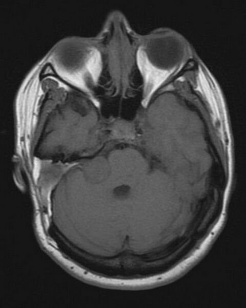File:Acoustic schwannoma (recurrent) (Radiopaedia 2575-6270 Axial T1 1).jpg