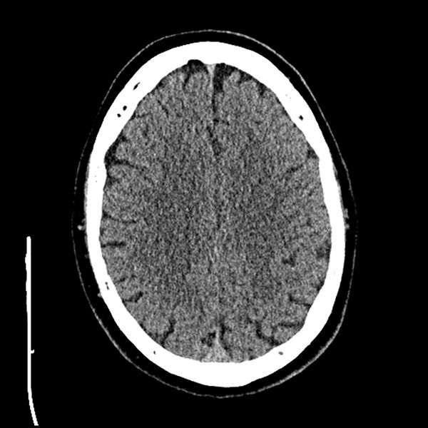 File:Acute A3 occlusion with ACA ischemic penumbra (CT perfusion) (Radiopaedia 72036-82525 Axial non-contrast thins 74).jpg