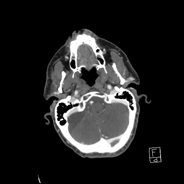 File:Acute ICA ischemic penumbra due to high-grade CCA stenosis (CT perfusion) (Radiopaedia 72038-82530 Axial C+ arterial phase 22).jpg
