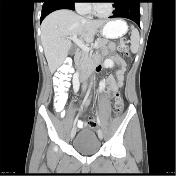File:Acute appendicitis (Radiopaedia 25364-25615 C+ portal venous phase 11).jpg