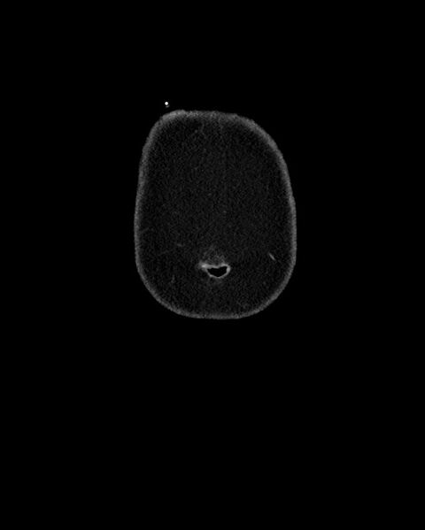 File:Acute appendicitis - large appendicoliths (Radiopaedia 61805-69820 Coronal C+ portal venous phase 4).jpg