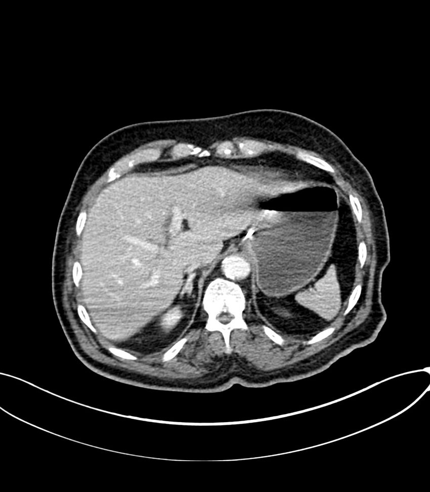 Acute arterial mesenteric ischemia (Radiopaedia 78238-90828 Axial C+ portal venous phase 30).jpg