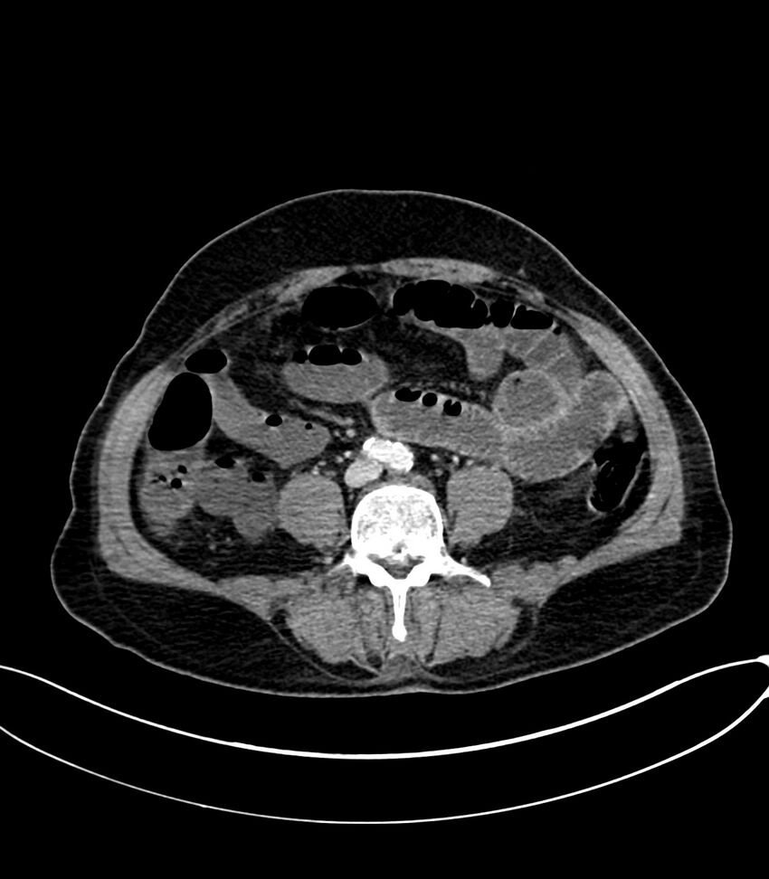 Acute arterial mesenteric ischemia (Radiopaedia 78238-90828 Axial C+ portal venous phase 85).jpg