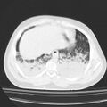Acute aspiration pneumonitis (Radiopaedia 33605-34703 Axial lung window 74).jpg