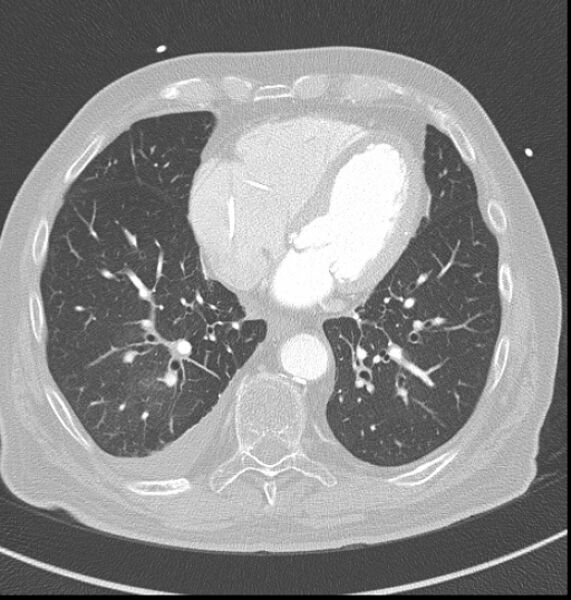 File:Acute myocardial infarction (Radiopaedia 23413-23481 lung window 48).jpg