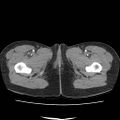 Acute myocarditis (Radiopaedia 55988-62613 Axial C+ portal venous phase 90).jpg
