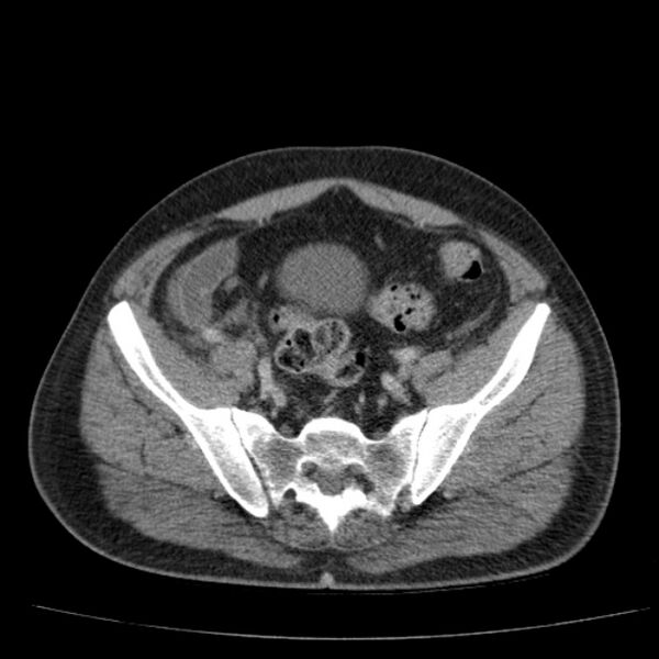 File:Acute pancreatitis (Radiopaedia 26663-26813 Axial C+ portal venous phase 69).jpg