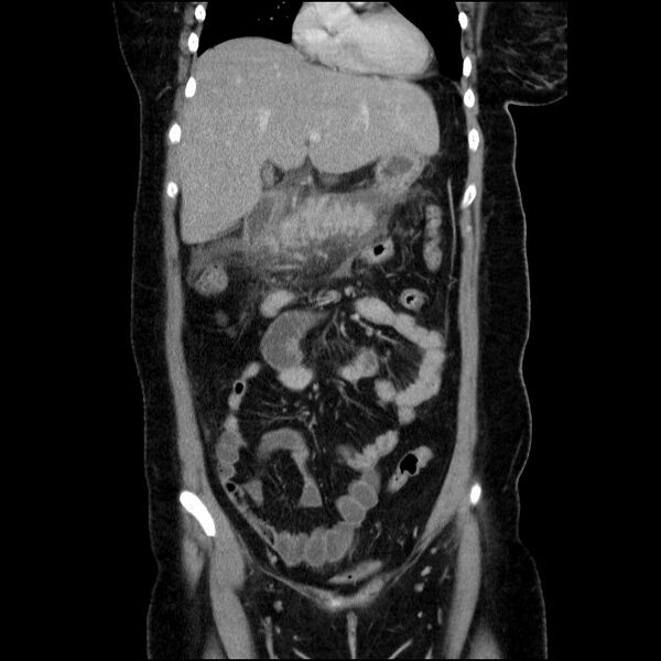File:Acute pancreatitis (Radiopaedia 69236-79012 Coronal C+ portal venous phase 49).jpg