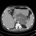 Acute pancreatitis with walled off pancreatic necrosis (Radiopaedia 6438-7797 Axial C+ portal venous phase 1).jpg