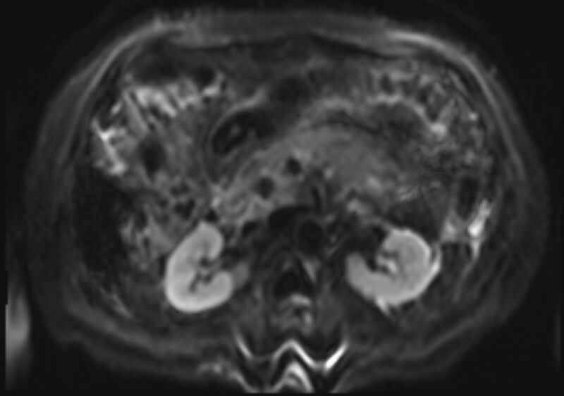 File:Acute portal vein thrombosis (Radiopaedia 73198-83925 Axial DWI 19).jpg