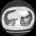 Acute pulmonary edema on CT (Radiopaedia 33582-34672 Axial lung window 44).jpg