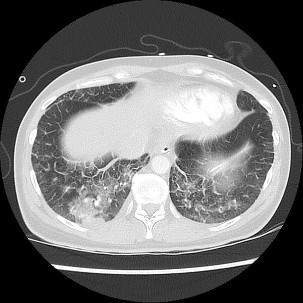 File:Acute pulmonary edema on CT (Radiopaedia 33582-34672 Axial lung window 44).jpg