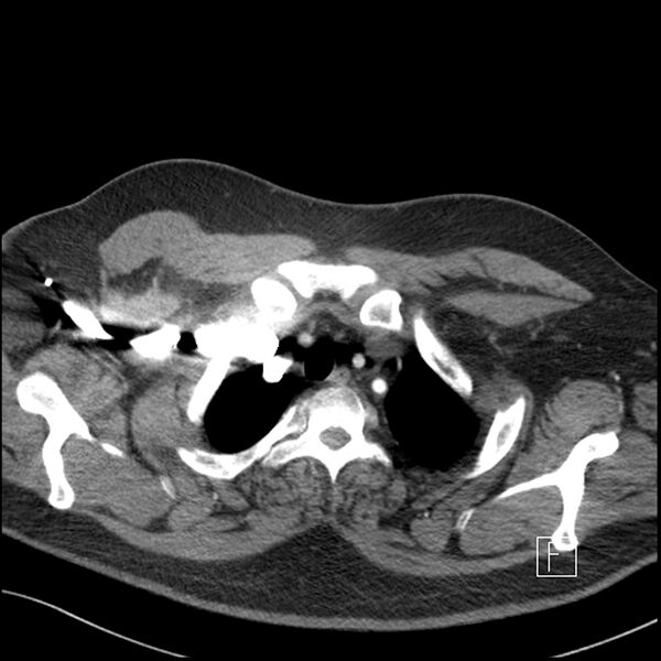 File:Acute pulmonary embolism with pulmonary infarct (Radiopaedia 73062-83768 Axial C+ CTPA 5).jpg