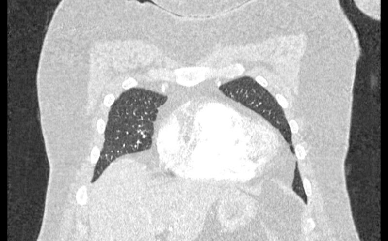 File:Acute pulmonary embolism with pulmonary infarcts (Radiopaedia 77688-89908 Coronal lung window 6).jpg