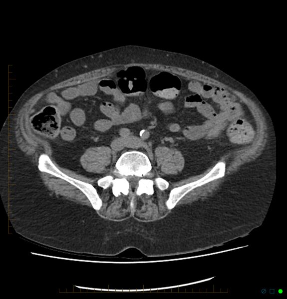 File:Acute renal failure post IV contrast injection- CT findings (Radiopaedia 47815-52557 Axial non-contrast 54).jpg