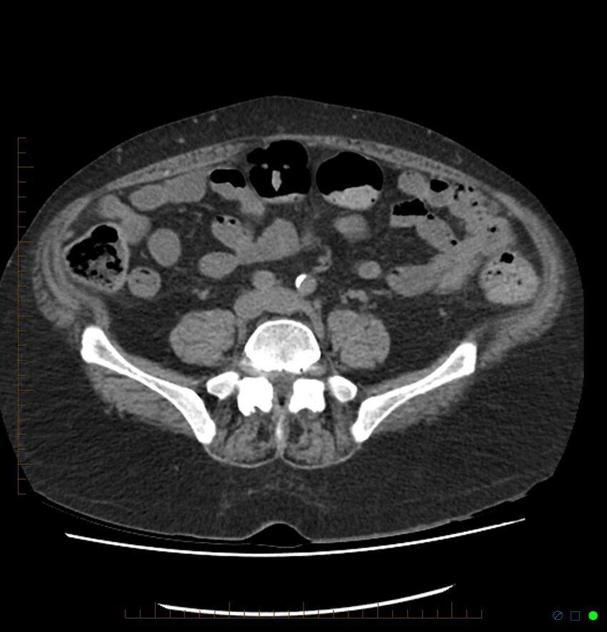 Acute renal failure post IV contrast injection- CT findings (Radiopaedia 47815-52557 Axial non-contrast 54).jpg