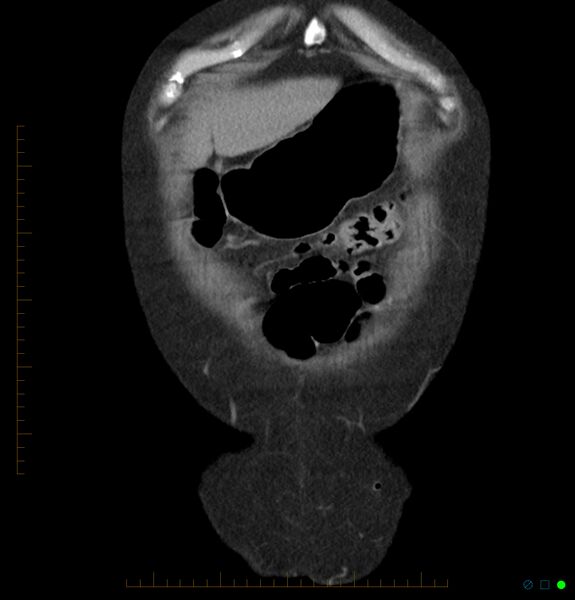 File:Acute renal failure post IV contrast injection- CT findings (Radiopaedia 47815-52557 Coronal non-contrast 1).jpg