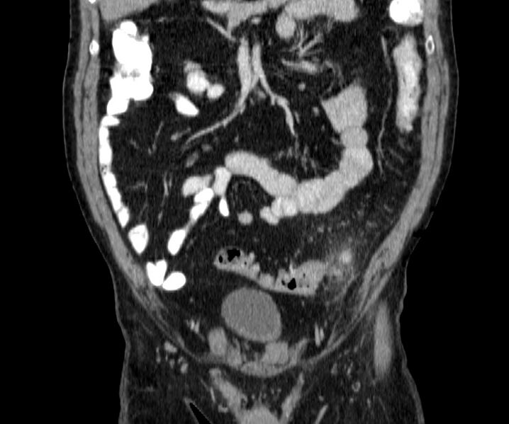 File:Acute sigmoid colon diverticulitis (Radiopaedia 55507-61976 Coronal C+ portal venous phase 43).jpg