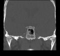 Acute sinusitis (Radiopaedia 23161-23215 Coronal bone window 57).jpg