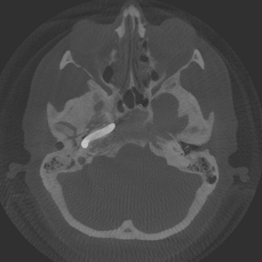 Acute subarachnoid hemorrhage and accessory anterior cerebral artery (Radiopaedia 69231-79010 Axial arterial - MIP 14).jpg