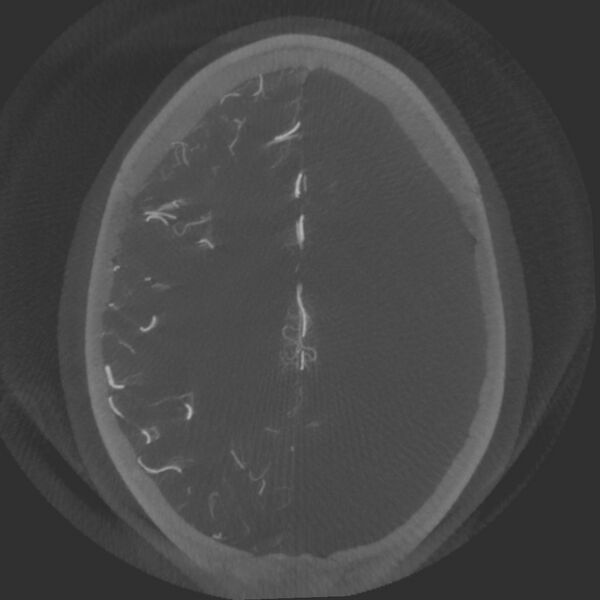 File:Acute subarachnoid hemorrhage and accessory anterior cerebral artery (Radiopaedia 69231-79010 Axial arterial - MIP 58).jpg