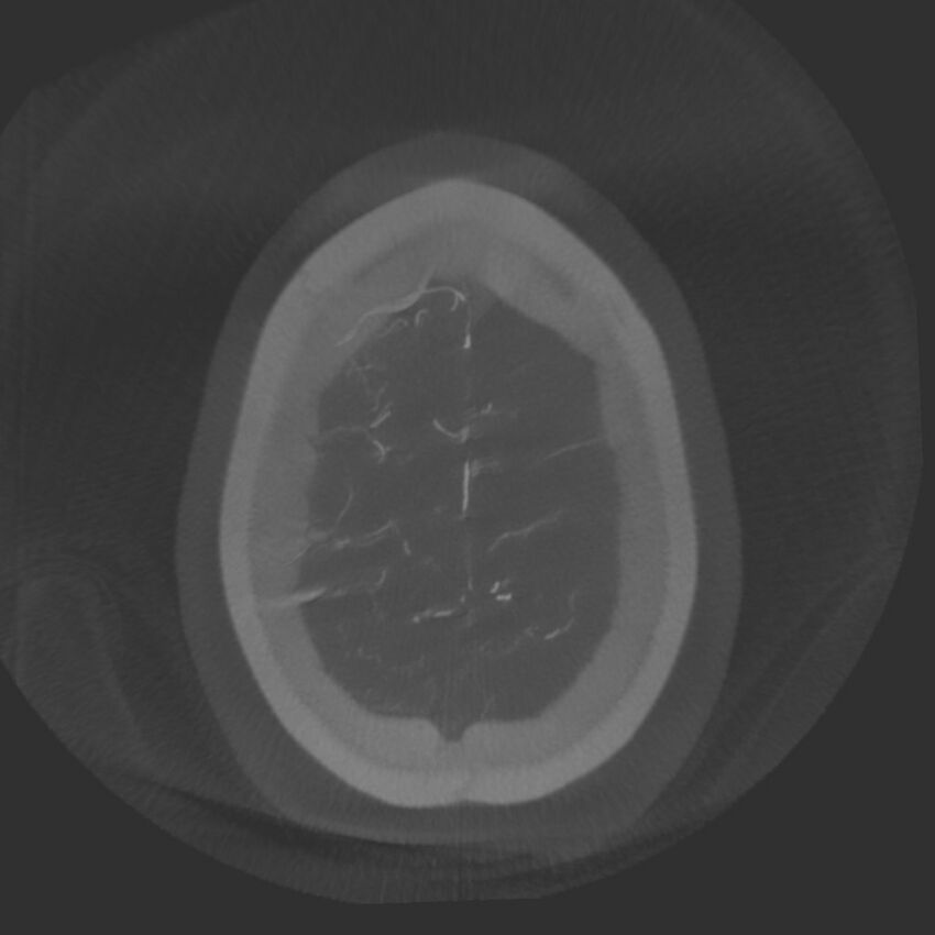 Acute subarachnoid hemorrhage and accessory anterior cerebral artery (Radiopaedia 69231-79010 Axial arterial - MIP 78).jpg