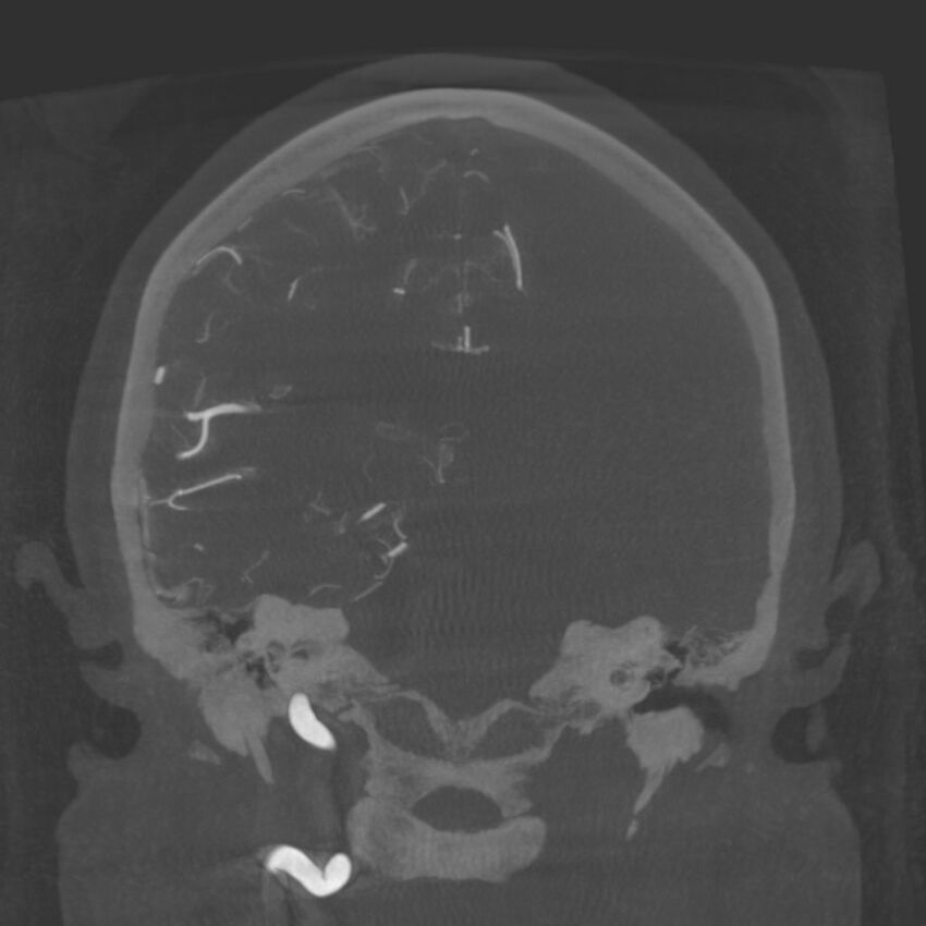 Acute subarachnoid hemorrhage and accessory anterior cerebral artery (Radiopaedia 69231-79010 Coronal arterial - MIP 62).jpg