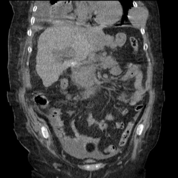 File:Acute tubular necrosis (Radiopaedia 28077-28334 D 37).jpg