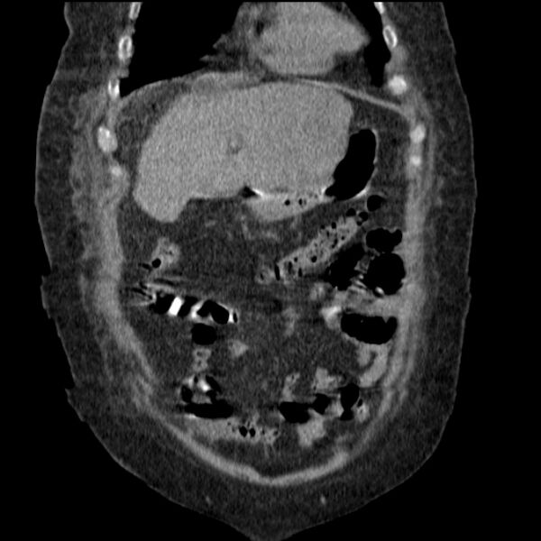 File:Acute tubular necrosis (Radiopaedia 28077-28334 G 24).jpg
