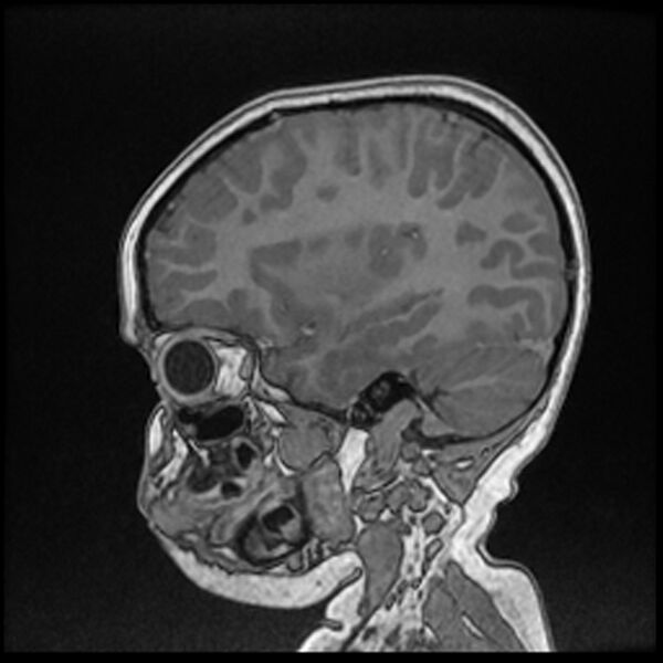 File:Adamantinomatous craniopharyngioma (Radiopaedia 77407-89529 Sagittal T1 C+ 40).jpg