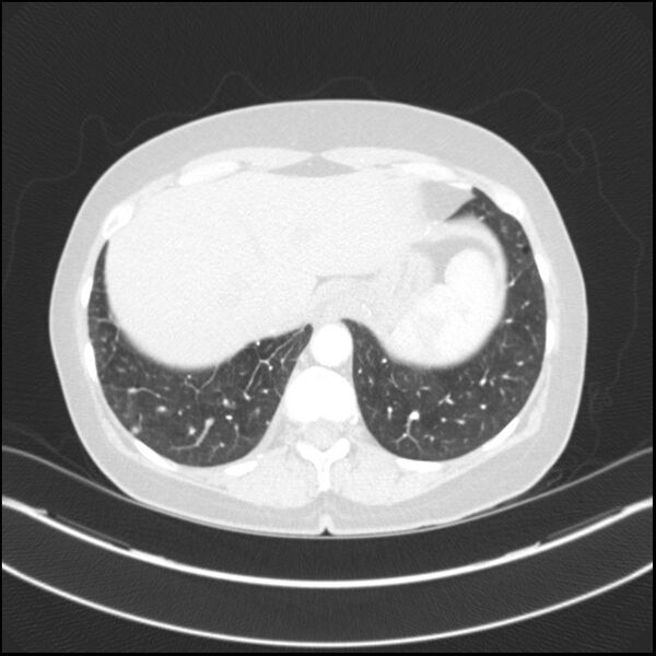 File:Adenocarcinoma of the lung (Radiopaedia 44205-47803 Axial lung window 76).jpg