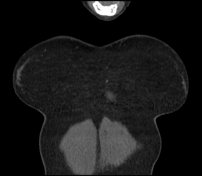 File:Adenocarcinoma of the lung (Radiopaedia 44205-47803 Coronal C+ portal venous phase 1).jpg