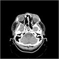 Adenoid cystic carcinoma of the lacrimal gland (Radiopaedia 10999-11416 Axial C+ arterial phase 1).jpg