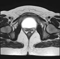 Adenomyosis - ovarian endometriomas (Radiopaedia 67031-76350 Axial T2 23).jpg