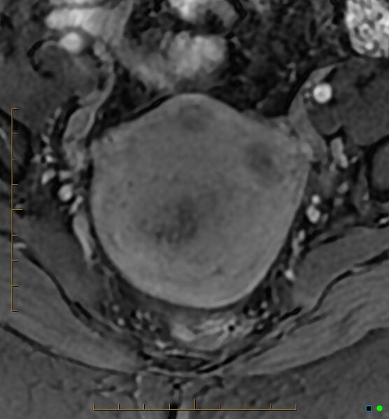 File:Adenomyosis uterus with hematometra (Radiopaedia 45779-50011 Axial T1 C+ fat sat 20).jpg