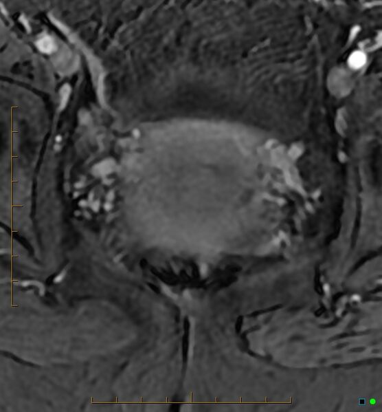 File:Adenomyosis uterus with hematometra (Radiopaedia 45779-50011 Axial T1 C+ fat sat 46).jpg