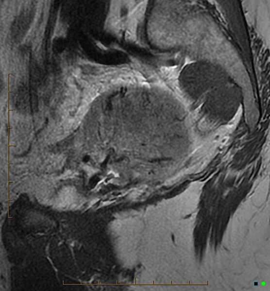 File:Adenomyosis uterus with hematometra (Radiopaedia 45779-50011 Sagittal T2 7).jpg