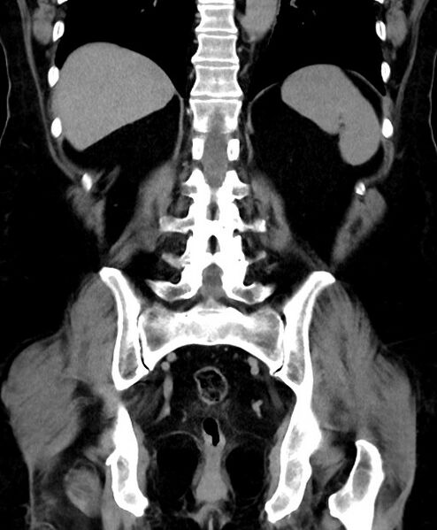 File:Adrenal cortical carcinoma (Radiopaedia 64017-72769 Coronal C+ delayed 45).jpg