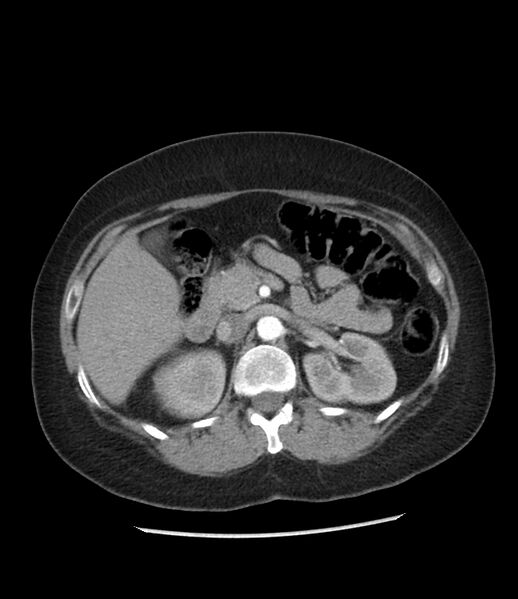 File:Adrenal cortical carcinoma with IVC invasion and thrombosis (Radiopaedia 34307-35597 Axial C+ arterial phase 32).jpg