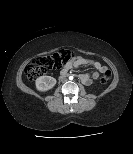 File:Adrenal cortical carcinoma with IVC invasion and thrombosis (Radiopaedia 34307-35597 Axial C+ arterial phase 46).jpg