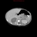 Adrenal hemorrhage (Radiopaedia 9390-10077 Axial C+ portal venous phase 7).jpg