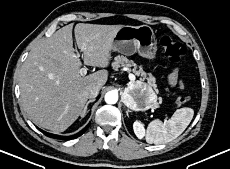 File:Adrenal metastases (Radiopaedia 73082-83791 Axial C+ arterial phase 41).jpg
