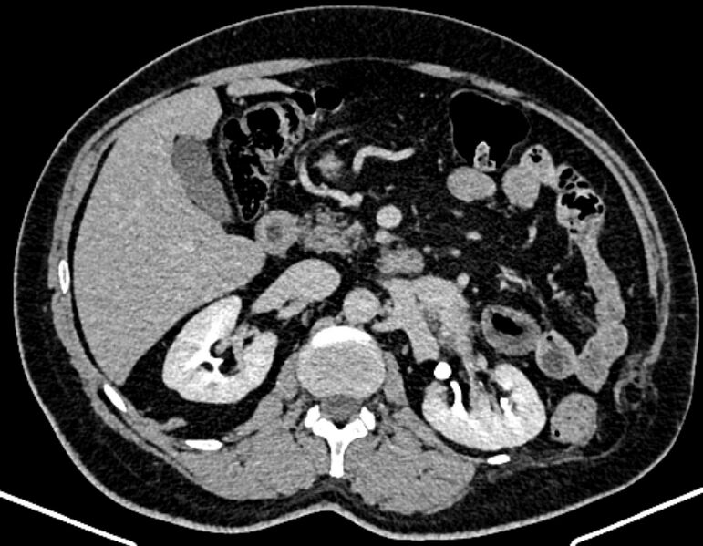 File:Adrenal metastases (Radiopaedia 73082-83791 Axial C+ delayed 130).jpg