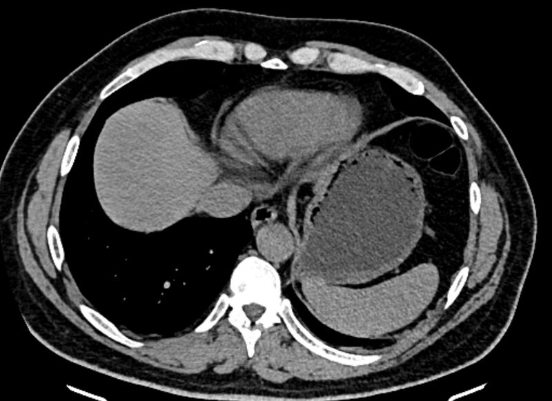 File:Adrenal metastases (Radiopaedia 73082-83791 Axial non-contrast 17).jpg
